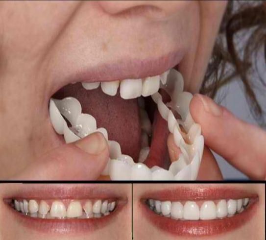 Fitflex Denture