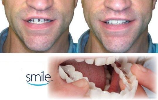 Fitflex Denture