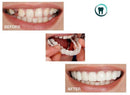 Fitflex Denture